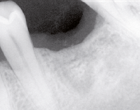 Septodont Case Studies: Post-extraction bone filling before implant placement
